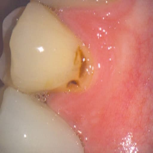 Foto intraoral de molar superior com cárie na face distal