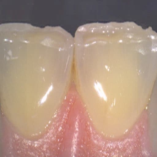 Foto intraoral dos incisivos centrais superiores