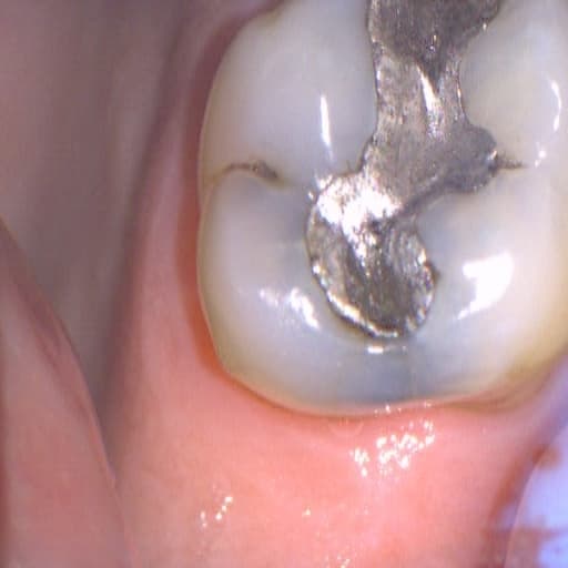 Foto intraoral de molar superior com restauração extensa em amálgama