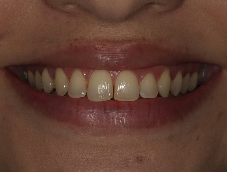 Fotografia do sorriso no início do acompanhamento